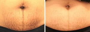 Striae1 1024x364