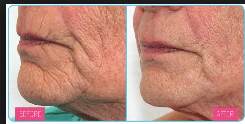 Meta Therapy by Dermatude