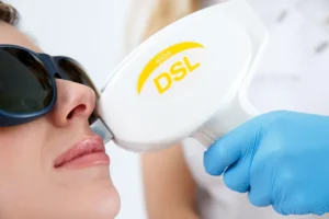 IPL laser treatment