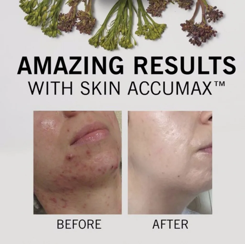 How to reduce post-acne pigmentation and scarring