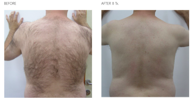 Laser Hair Removal