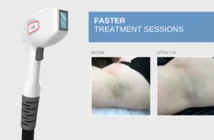 Laser hair removal Den Haag