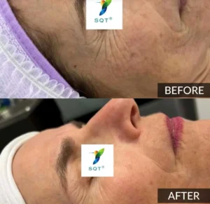 Ervaar de SQT Bio Microneedling Gezichtsbehandeling bij ASPA Den Haag.